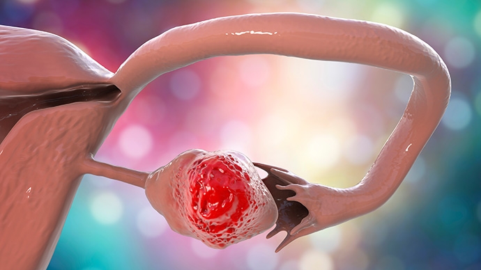 Ovarian Cancer Screening HK | CA125 Index & Pelvic Ultrasound Guide